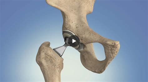 hip replacement aberdeen|Hip surgery in Aberdeen .
